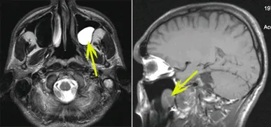 Szakértő MRI, MRI betegségekkel az orrmelléküregek