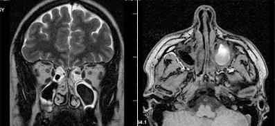 Szakértő MRI, MRI betegségekkel az orrmelléküregek