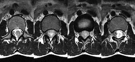 MRI az ágyéki gerinc, az ágyéki diagnózis