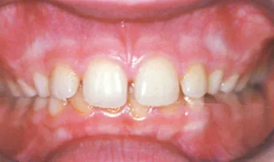 Захапка - необходимостта от ортодонтско лечение