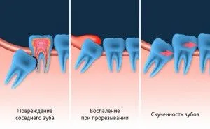 Трябва ли да се премахне мъдреци и защо