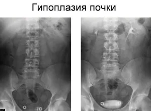 Trebuie să fug la medic, în cazul în care un rinichi este mai mic decât celălalt