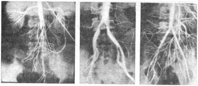 Atherosclerosis az aorta és a fő artériák az alsó végtagok