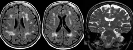 Examenul de măduvă și diagnostic vascular cerebral