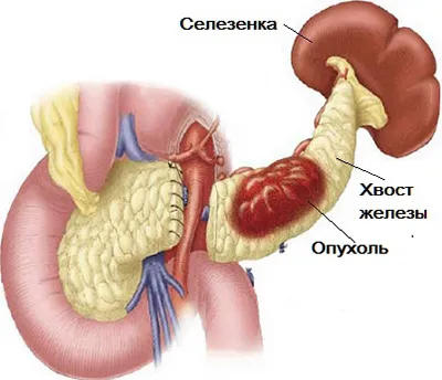 Operația asupra pancreasului, unde și cum să facă, și complicațiile care pot fi după laparoscopie