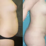 Характеристики на свидетелство цената на корема miniabdominoplastiki (преди и след снимки)