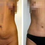 Jellemzői a has miniabdominoplastiki vallomást ár (előtti és utáni képek)