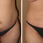 Характеристики на свидетелство цената на корема miniabdominoplastiki (преди и след снимки)