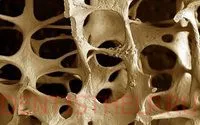 Osteoporosis állkapocs kezelésére és a betegség tüneteit; fogak első tünetek a csontritkulás