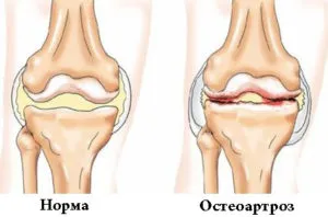 Коляно остеоартрит лечение, 1, 2, 3, степента на симптомите, лекува традиционните методи LFK