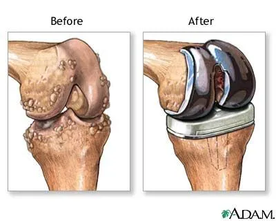 Osteoartrita Tratamentul medical blog-ul ambulanta doctor