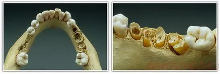 Osteoporosis állkapocs kezelésére és a betegség tüneteit; fogak első tünetek a csontritkulás