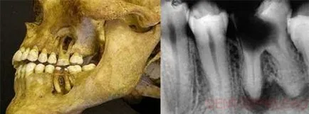 Остеопорозата челюст - причини, патогенеза и развитие на съвременни подходи за лечение