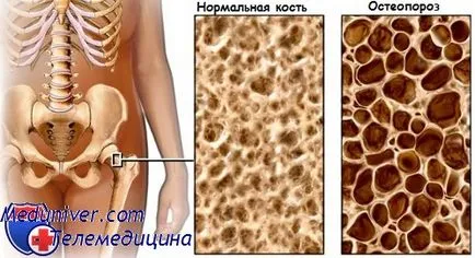 Остеопороза или защо често счупване на кости, за предотвратяване на остеопороза