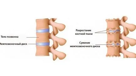 Simptomele osteohondroză și tratament