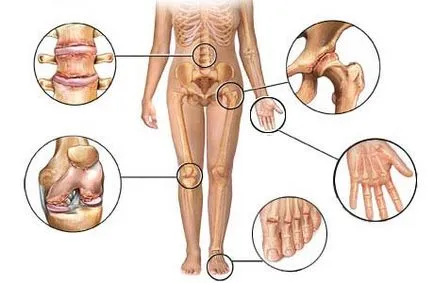 Osteoartrita Tratamentul medical blog-ul ambulanta doctor