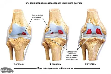 Коляно остеоартрит лечение, 1, 2, 3, степента на симптомите, лекува традиционните методи LFK