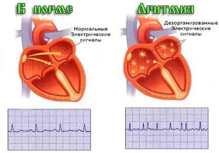 fibrilație atrială Mai ales a inimii - simptomele și tratamente, tratament la domiciliu