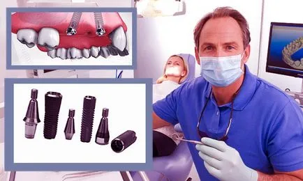 Vélemények a fogászati ​​implantátumok osstem, értékelése minőség implantátumok egy világszerte elismert
