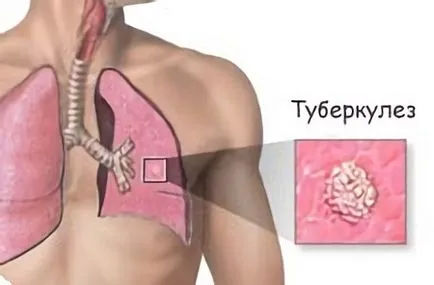 Bee Podmore származó prosztatagyulladás milyen formában és hogyan kell alkalmazni