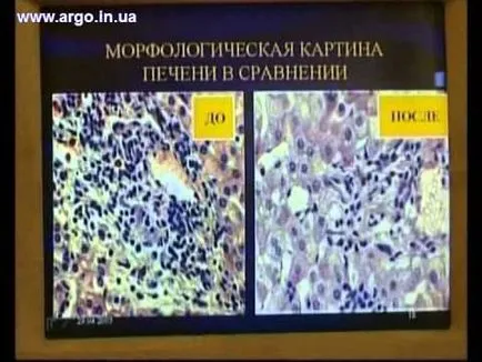 Паразити, Giardia в черния дроб на човека симптоми и лечение при възрастни