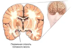 Пече се в причините за глава