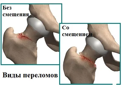 Fractura femurale simptomele gatului, cauzele si tratamentul