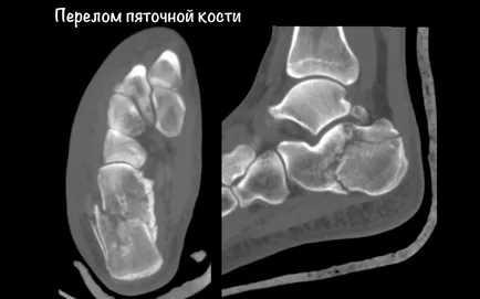 Törés a sarokcsont tünetek, kezelés és rehabilitáció