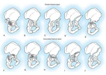 Fractura a acetabulului și fără părtinire offset, tratament, reabilitare