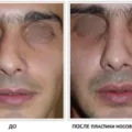 Miután septoplasty orron ellátás, rehabilitáció, restaurálás