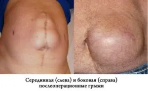 Műtét utáni hasi sérv fotók, hogyan lehet azonosítani
