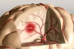 Consecințele accident vascular cerebral