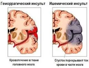 Consecințele accident vascular cerebral