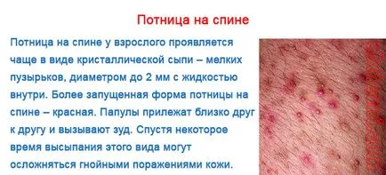 Sudamen възрастни - снимки, симптоми и лечение на проявите на бодлив топлина