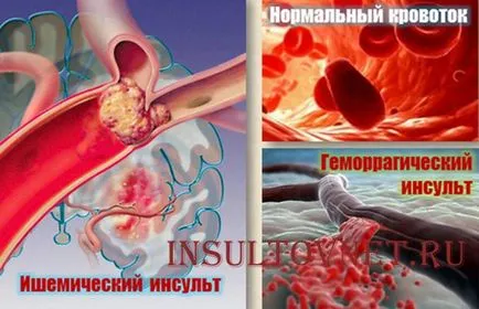 Dreapta consecințele accident vascular cerebral hemoragic si tratament