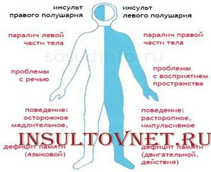 Дясна последствията от хеморагичен инсулт и лечение