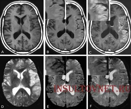 Dreapta consecințele accident vascular cerebral hemoragic si tratament