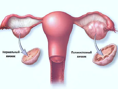 Cauzele pe termen lung lunar (menstruației prelungit) la femei