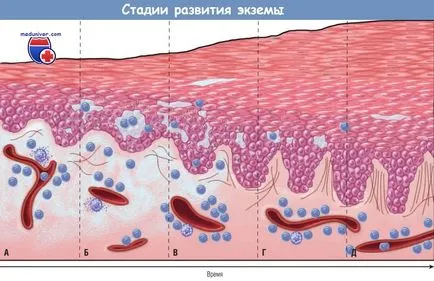 Az okok és mechanizmusok fejlesztése ekcéma (ekcémás dermatitis)