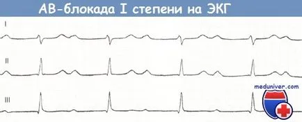 Semne de bloc AV de gradul întâi pe ECG