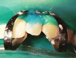 Директен намаляване на коронарната част на зъба с композитен материал в запълване МН - терапия -