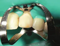 Директен намаляване на коронарната част на зъба с композитен материал в запълване МН - терапия -
