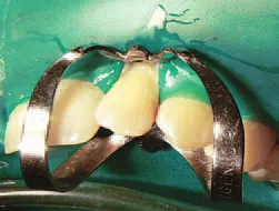Reducerea directă a porțiunii coronară a dintelui cu un material compozit c-umplere mh - terapie -
