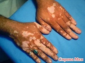 megnyilvánulásai vitiligo