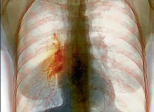 Рак на десния бял дроб
