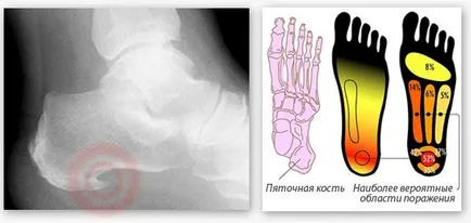 Heel стимул - симптоми, лечение