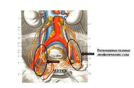 Endometriális rák - tünetek, diagnózis és a kezelés méhtest rák különböző szakaszaiban