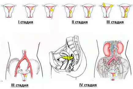 Endometriális rák - tünetek, diagnózis és a kezelés méhtest rák különböző szakaszaiban