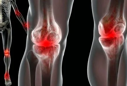 Reaktív arthritis tünetei és kezelése