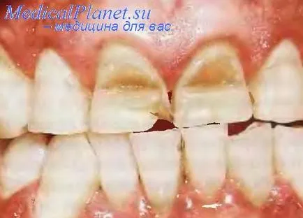 Újratelepítése periodontitis